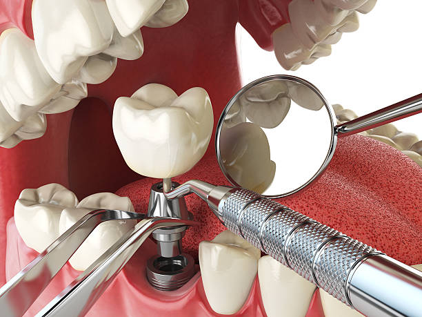 Best Emergency Dentist for Lost Fillings or Crowns in Remsen, IA